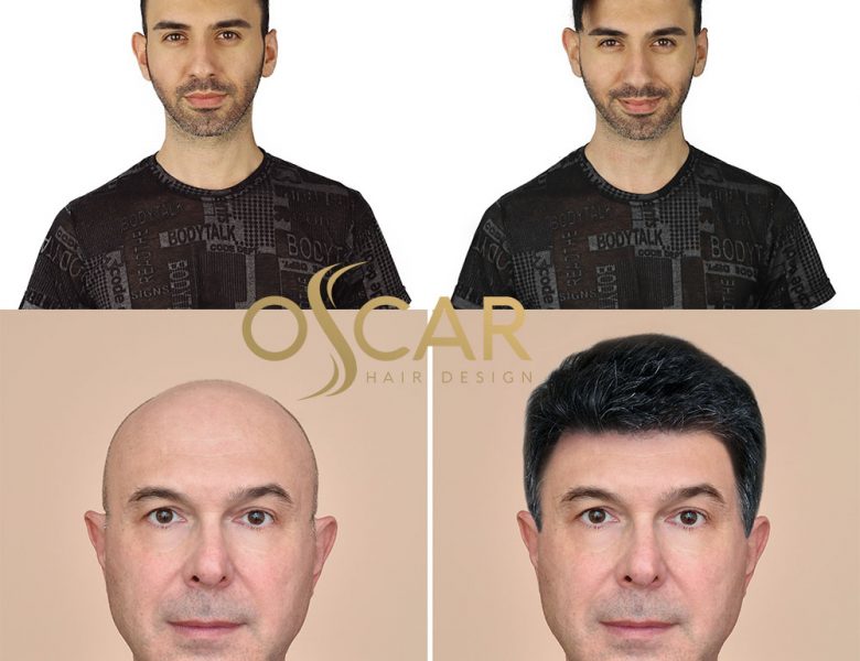 En Uygun Protez Saç Fiyatları Oscar Hair Protez Saç Merkezinde