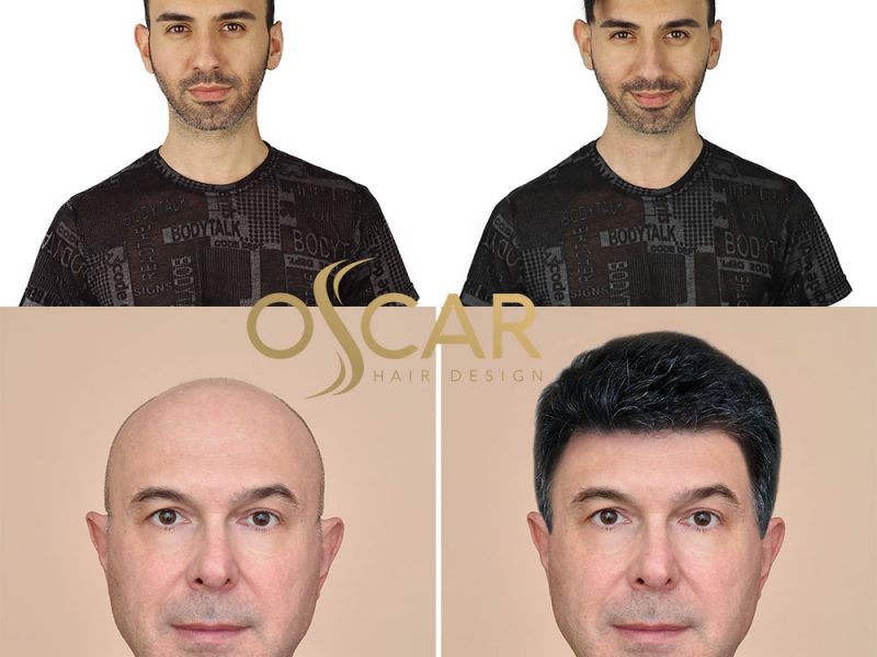 En Uygun Protez Saç Fiyatları Oscar Hair Protez Saç Merkezinde